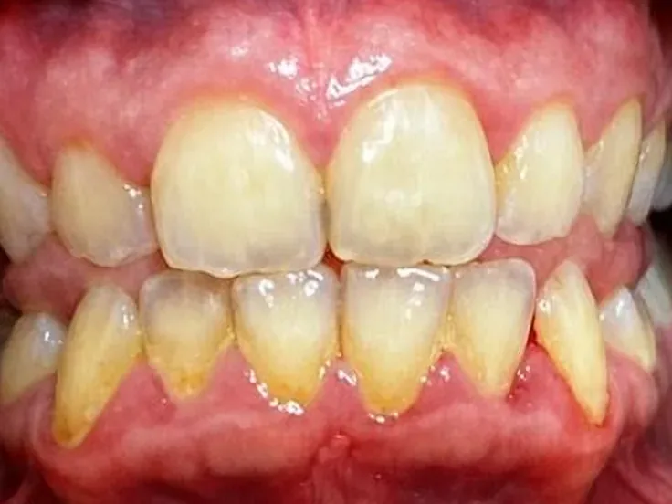 Antes: dientes con sarro y manchas amarillas