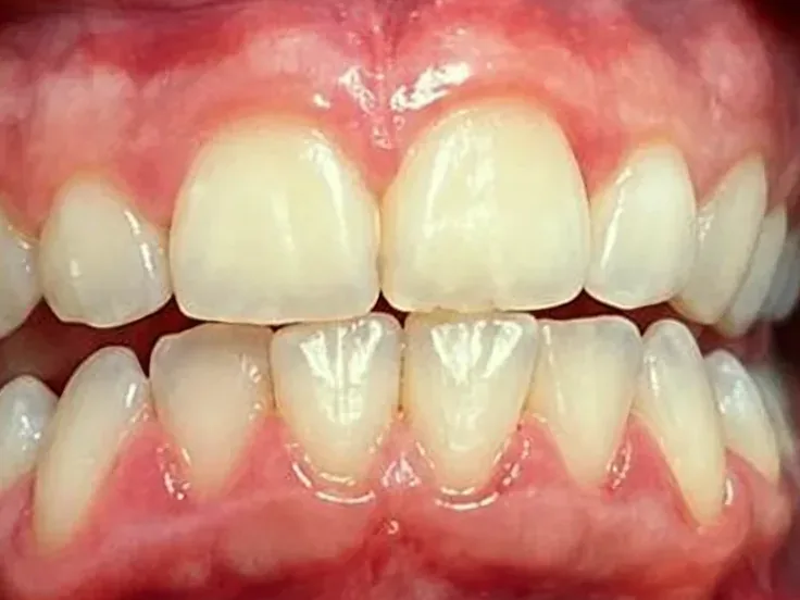 Después: dientes limpios y de tono más claro