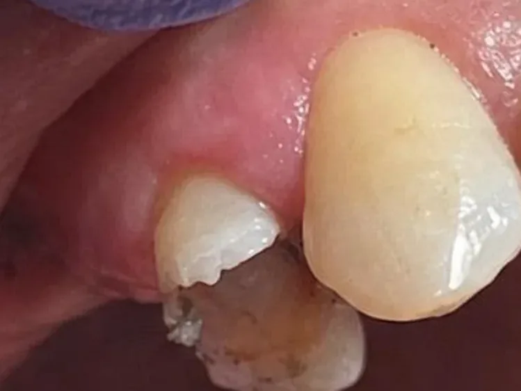Antes: diente lateral fracturado y con caries