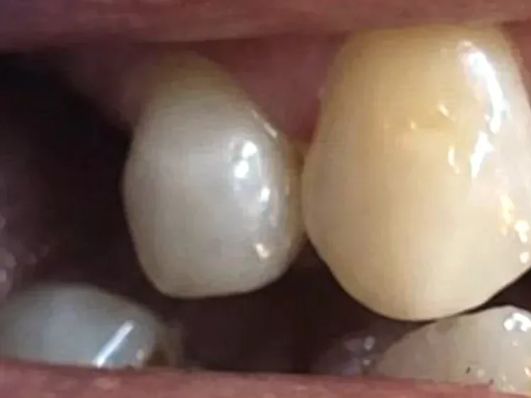 Después: diente lateral restaurado con su forma completa