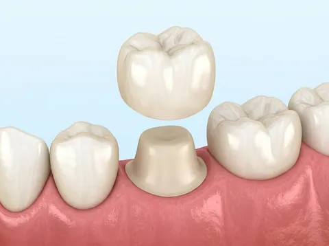 Ilustración de una corona dental a punto de colocarse sobre un diente