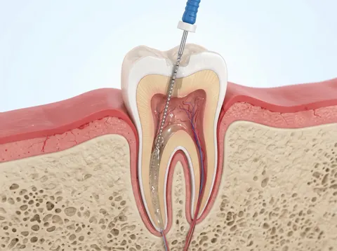 Ilustración en corte de una muela con una lima dental limpiando sus conductos