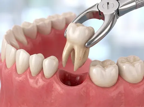 Ilustración de un diente siendo extraído con un fórceps dental