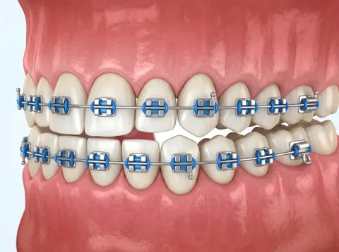 Ilustración de dientes con frenillos metálicos