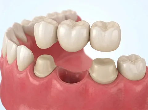 Ilustración de un puente fijo apoyado en dos dientes vecinos